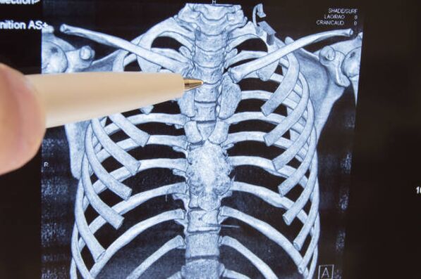 mellkasi gerinc kenőcsének osteochondrosis poliklinikus fájdalom az ujjak ízületeiben
